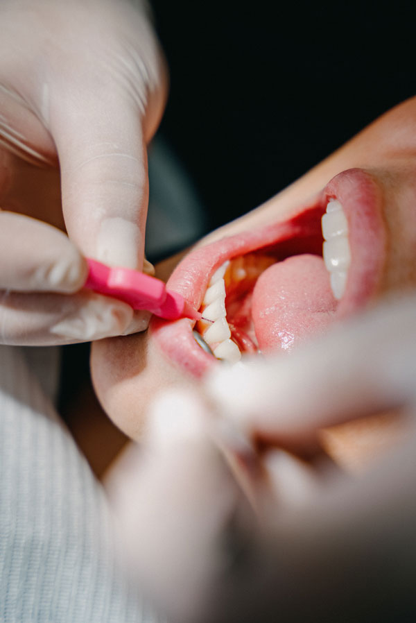 Reinigung der Zahnzwischenräume bei der professionellen Zahnreinigung im MVZ Rage-Holm Bocholt